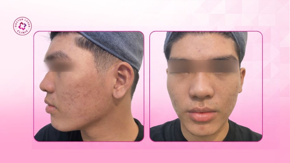 sau điều trị giảm mụn viêm cải thiện sẹo rỗ