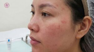 sau khi điều trị sẹo rỗ da có mỏng hoặc yếu hơn không