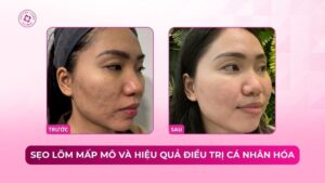 sẹo lõm mấp mô và hiệu quả điều trị cá nhân hoá sẹo lõm mấp mô và hiệu quả điều trị cá nhân hoá