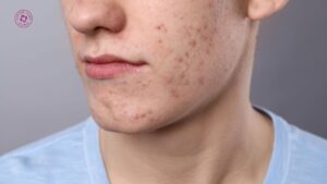 sẹo rỗ đã điều trị rồi làm lại cải thiện được không sẹo rỗ đã điều trị rồi làm lại cải thiện được không