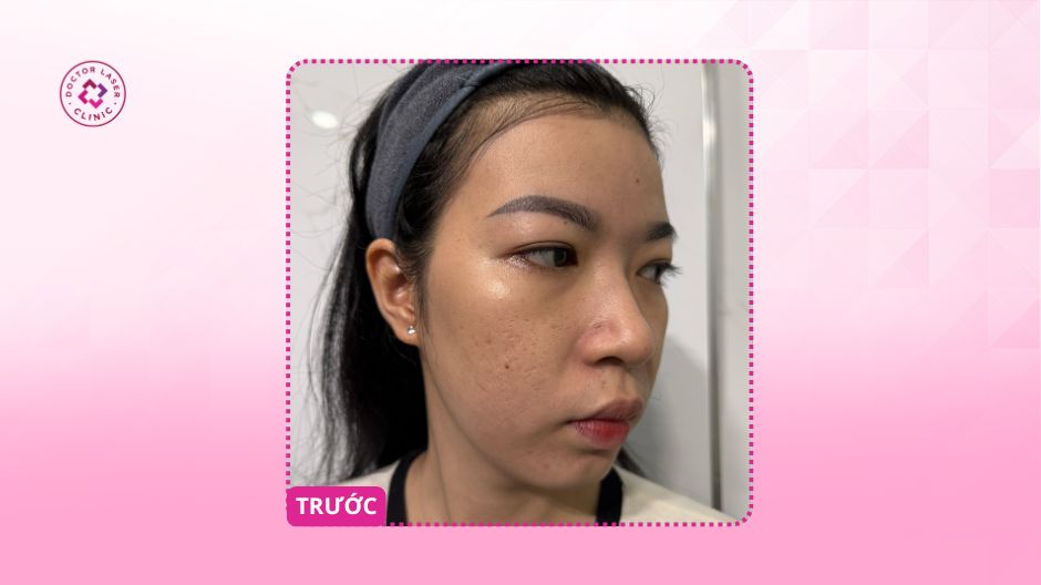 sẹo rỗ đáy nhọn đáy vuông trước điều trị