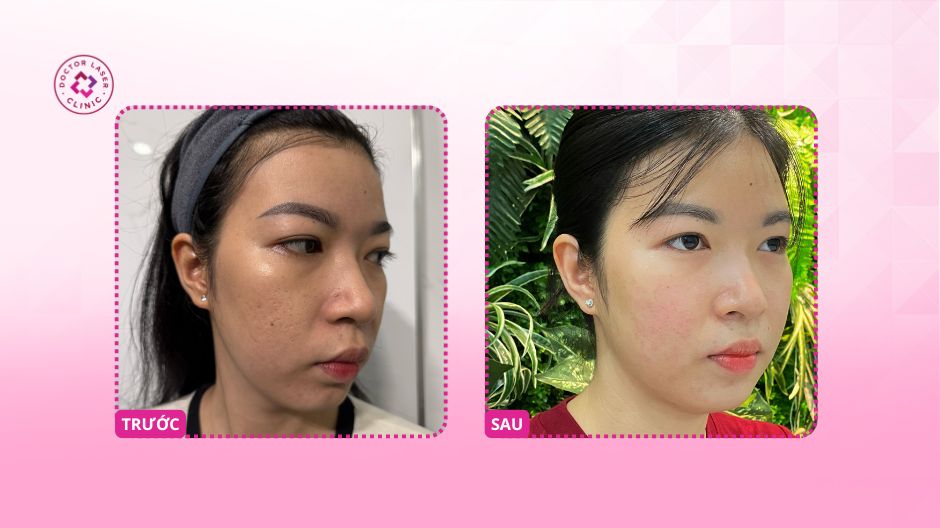 sẹo rỗ đáy nhọn đáy vuông trước sau laser co2