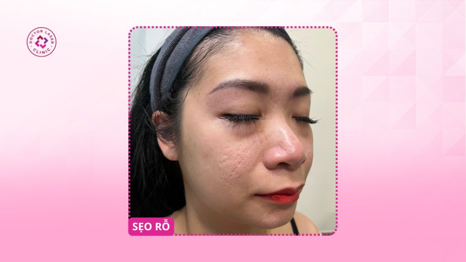 sẹo rỗ lâu năm trước điều trị 32 tuổi ở đức