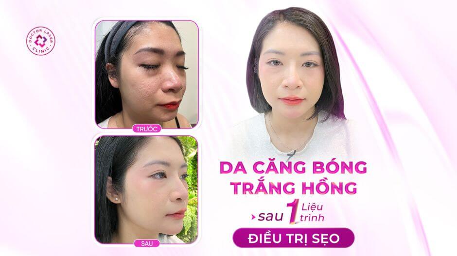 sẹo rỗ trước sau 1 liệu trình tại doctor laser