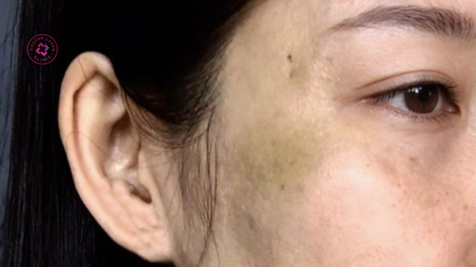 sưng bầm sau căng chỉ thái dương