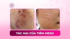 tác hại của tiêm meso