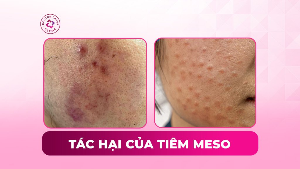 Tác hại của tiêm meso có ảnh hưởng đến sức khỏe không?