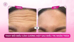 thay đổi biểu cảm gương mặt sau điều trị nhăn trán