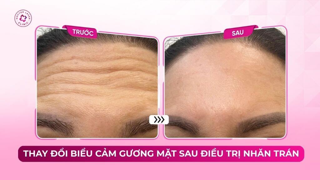 Thay đổi biểu cảm gương mặt sau điều trị nhăn trán
