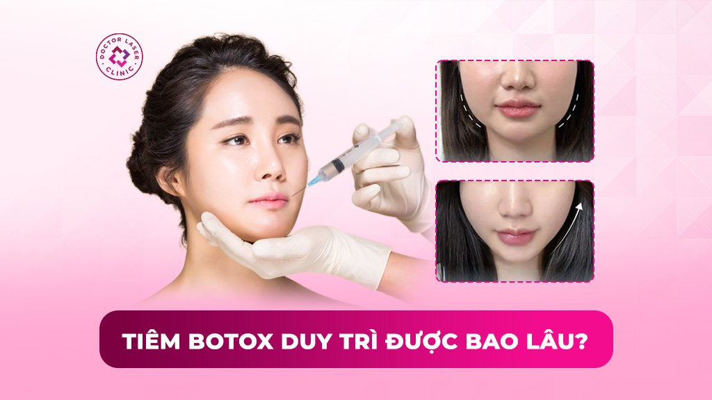 Tiêm botox duy trì được bao lâu? Khi nào nên tiêm nhắc lại?