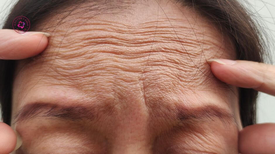 tiêm botox xoá nhăn trán