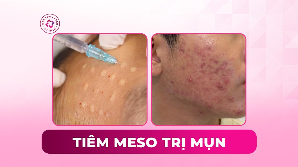 Tiêm meso trị mụn khi nào nên thực hiện? Có rủi ro không?