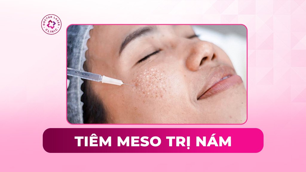 Tiêm meso trị nám có hiệu quả không? Bao lâu thì hết?