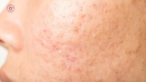 trong điều trị sẹo rỗ cần ngưng hoặc giãn liệu trình không trong điều trị sẹo rỗ cần ngưng hoặc giãn liệu trình không