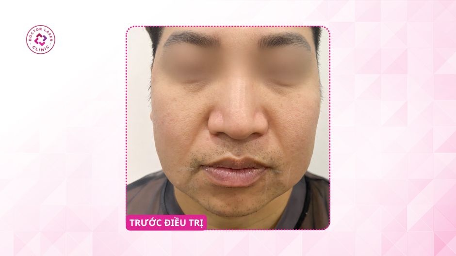 trước điều trị mỡ nọng cằm laserlift 1330
