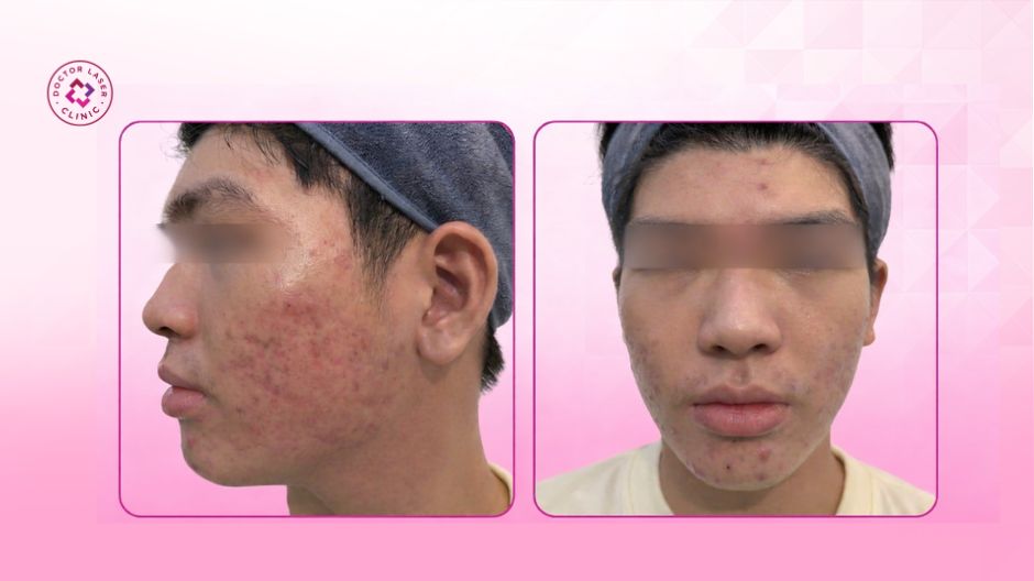 trước điều trị mụn viêm sẹo rỗ bệnh nhân 16 tuổi