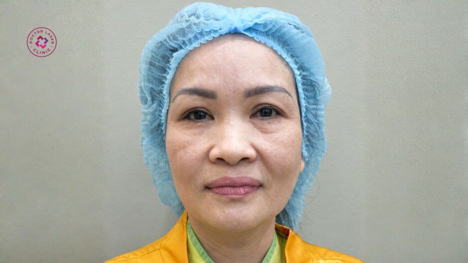 trước khi điều trị chảy xệ da mặt