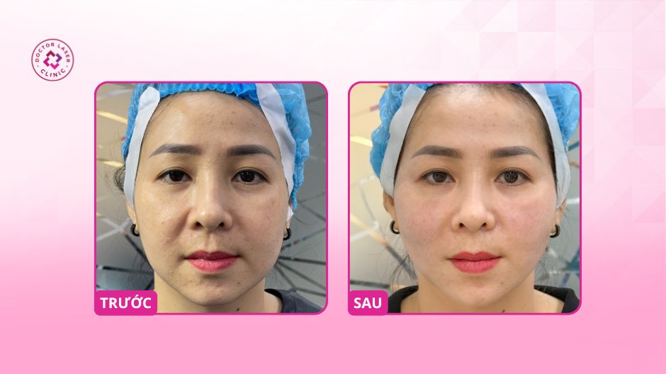 trước sau căng chỉ nâng cơ cải thiện lão hoá da