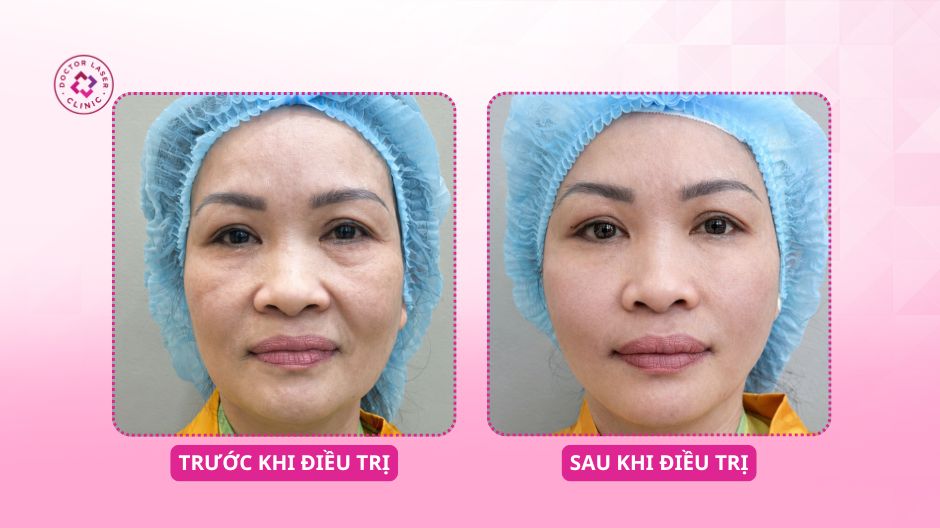 trước sau căng chỉ nâng cơ chảy xệ da mặt