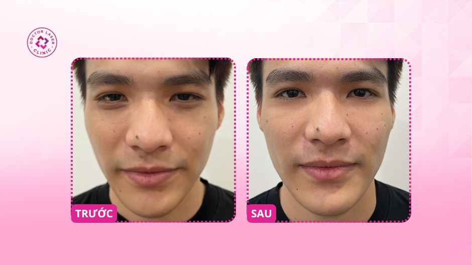 trước sau điều trị quầng thâm mắt bằng filler