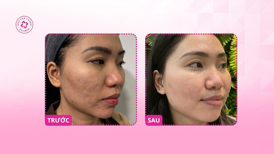 trước sau điều trị sẹo lõm da mặt