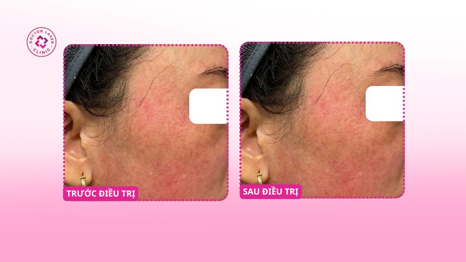 trước sau phục hồi da đỏ yếu prp doctor laser