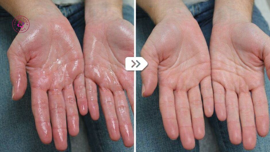 trước sau tiêm botox trị mồ hôi tay