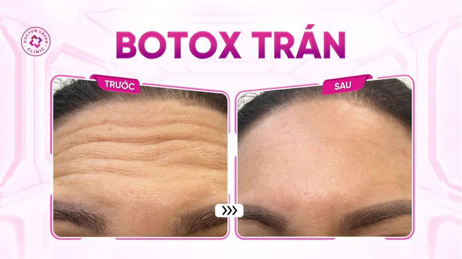 trước sau tiêm botox xoá nhăn trán