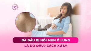 ba-bau-bi-mun-lung-la-do-dau-cach-xu-ly Bà bầu bị mụn lưng là do đâu? Cách xử lý