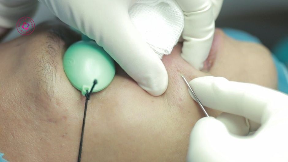 bóc tách đáy sẹo nâng vùng lõm