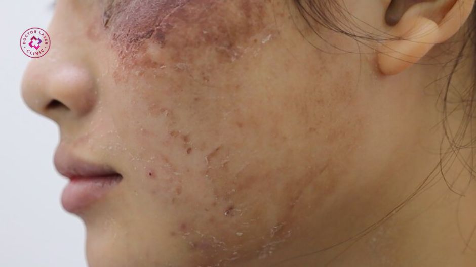 bỏng da sau peel