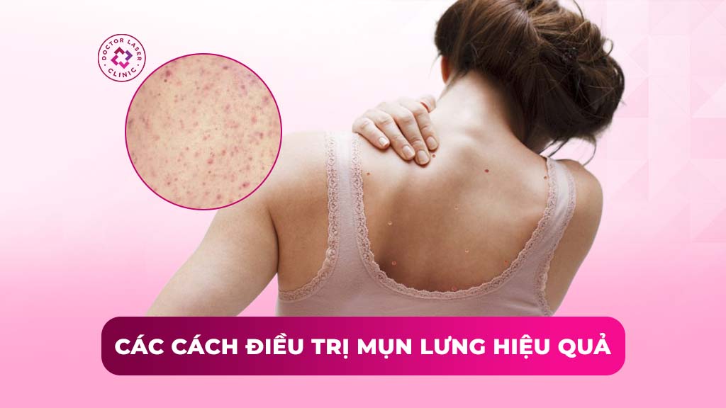 Các cách điều trị mụn lưng hiệu quả và nhanh chóng hiện nay