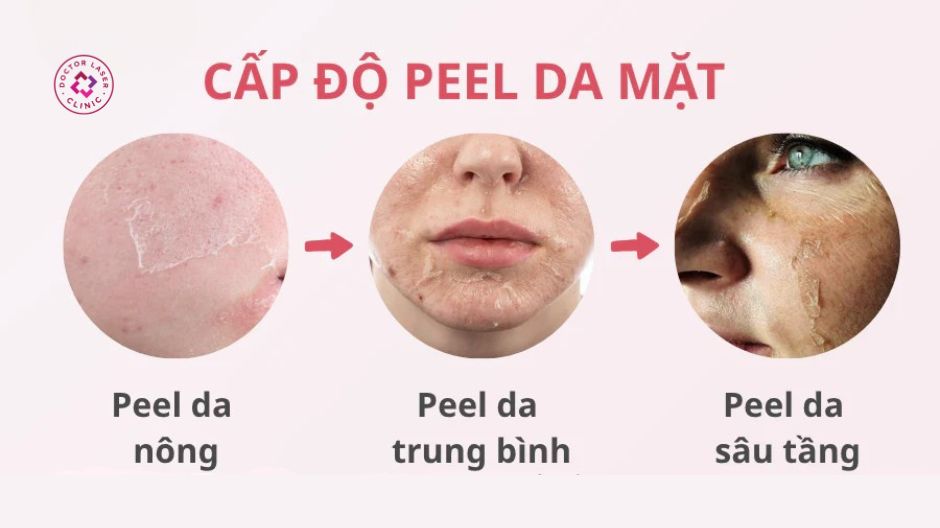 các cấp độ peel da nông trung bình sâu và thời gian phục hồi