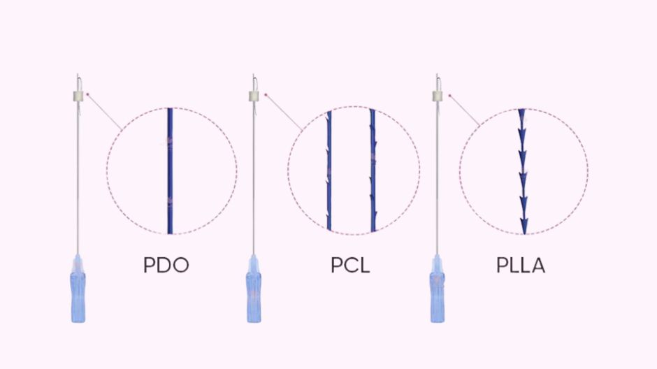 các loại chỉ căng da mặt