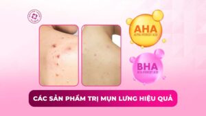 các sản phẩm trị mụn lưng hiệu quả các sản phẩm trị mụn lưng hiệu quả