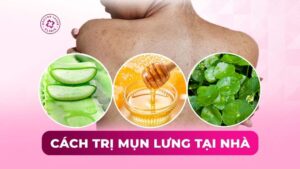 cách trị mụn lưng tại nhà