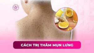 cách trị thâm mụn lưng cách trị thâm mụn lưng