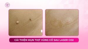 cải thiện mụn thịt vùng cổ sau laser co2 cải thiện mụn thịt vùng cổ sau laser co2