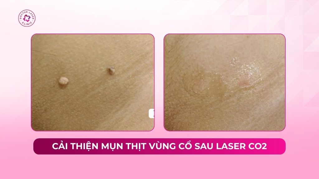 cải thiện mụn thịt vùng cổ sau laser co2