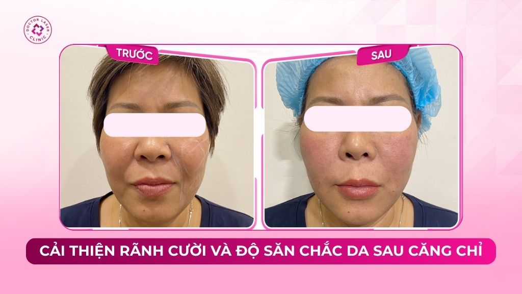 Cải thiện rãnh cười và độ săn chắc da sau căng chỉ