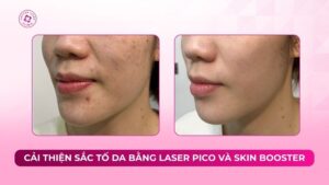 cải thiện sắc tố da bằng laser pico và skin booster