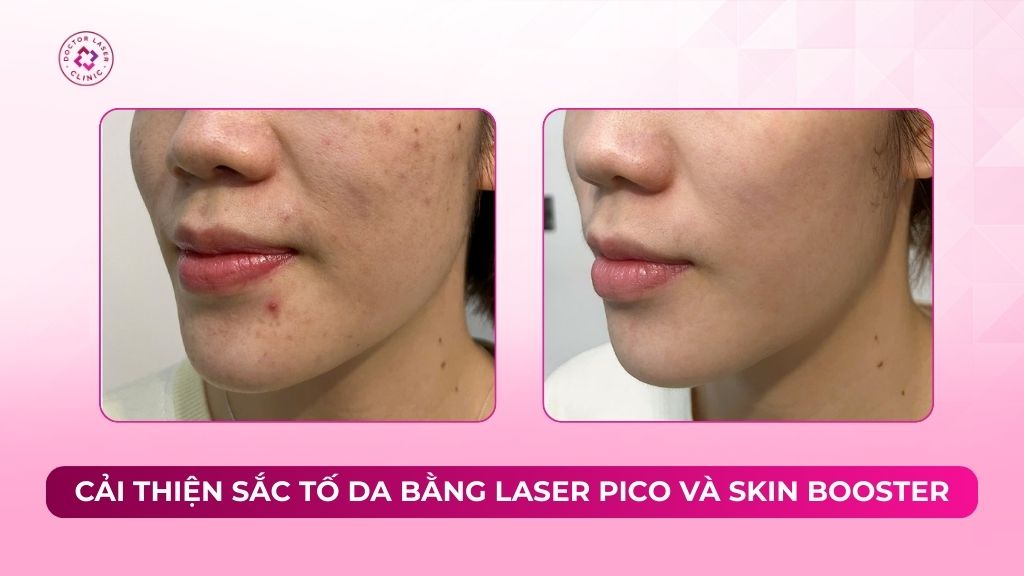 cải thiện sắc tố da bằng laser pico và skin booster