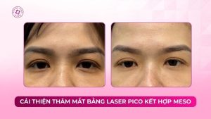 cải thiện thâm mắt bằng laser pico kết hợp meso