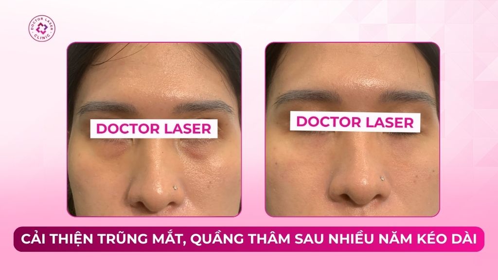 Cải thiện trũng mắt, quầng thâm sau nhiều năm kéo dài