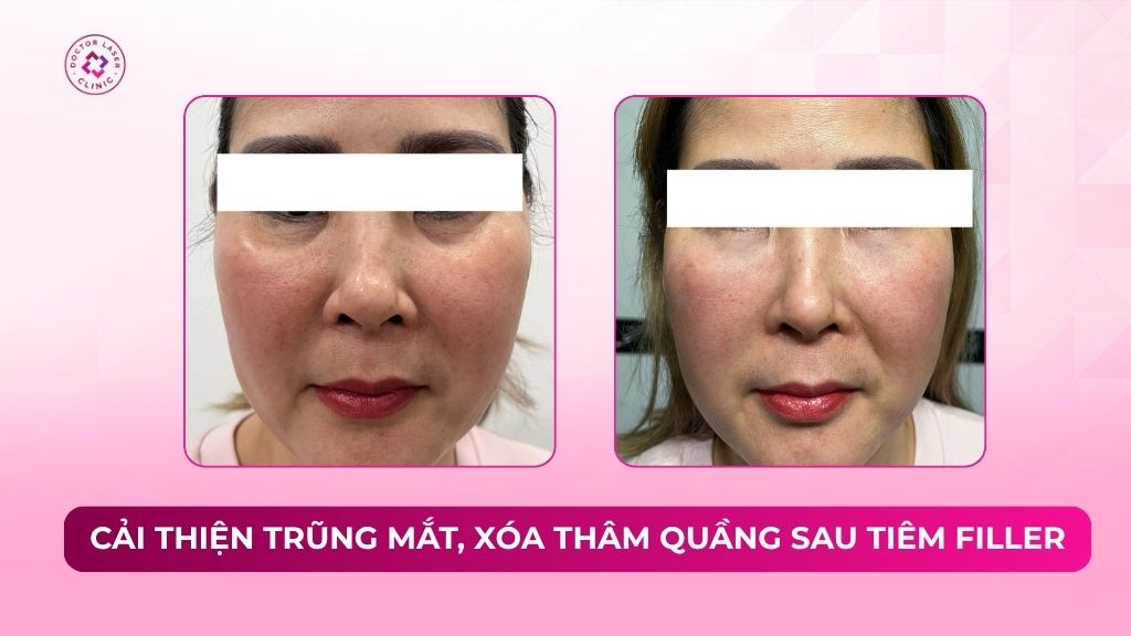 cải thiện trũng mắt xoá thâm quầng sau tiêm filler