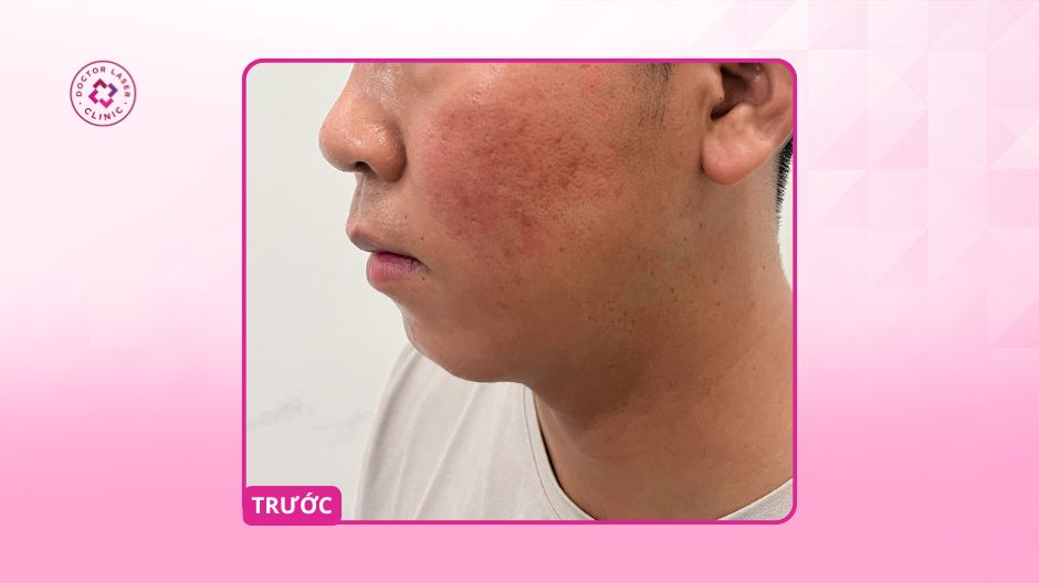 cằm ngắn lẹm trước điều trị nam giới