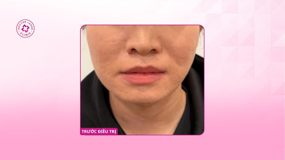 cằm trước khi điều chỉnh bằng filler