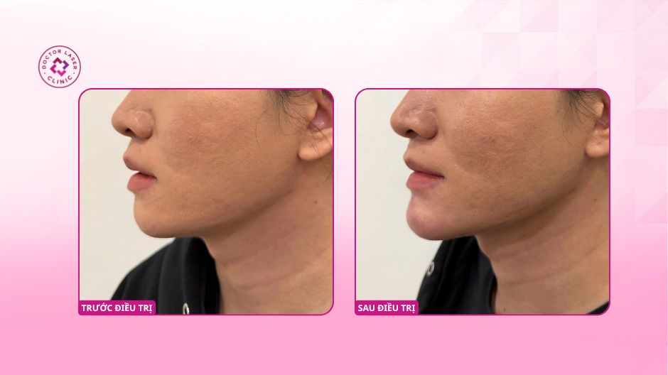 cằm trước sau điều chỉnh góc nghiêng