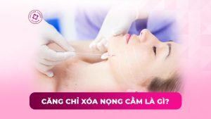 căng chỉ xóa nọng cằm là gì