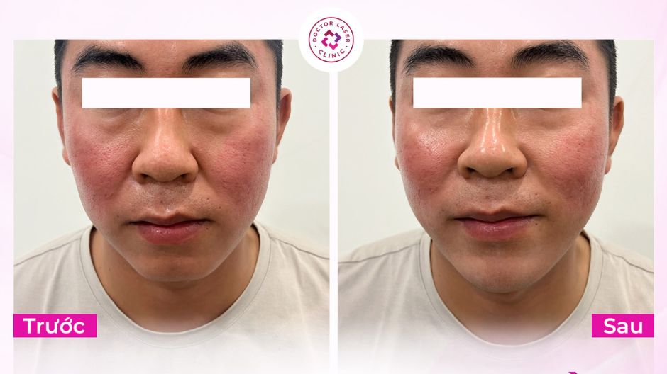 case tiêm cằm với 1cc ha